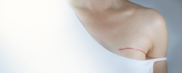 complications-long-terme-mastectomie